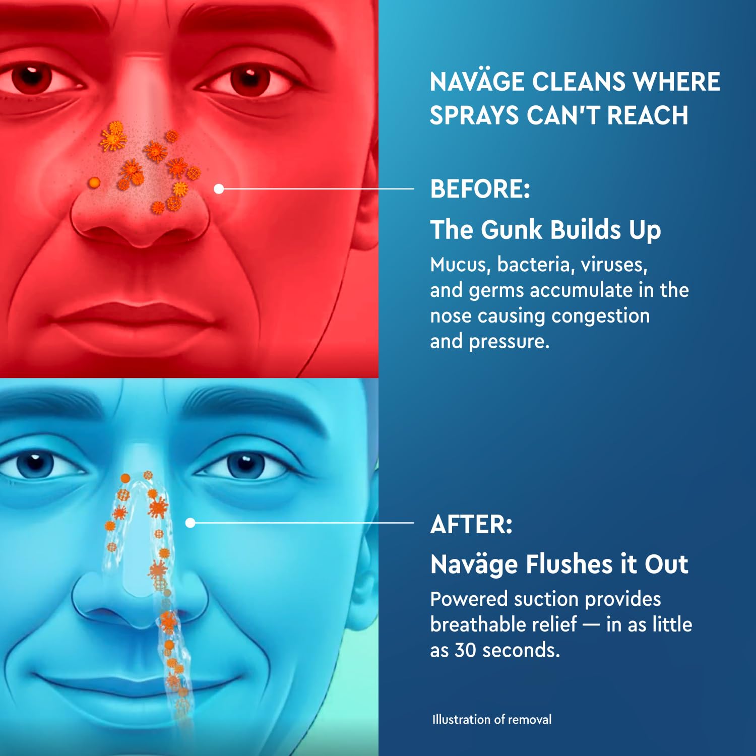 Navage® Starter Bundle – Nasal Irrigation System - Saline Nasal Rinse Kit with 1 Nose Cleaner and 20 SaltPods for Congestion Relief ($109 Value). Sinus Rinse for Clinically Proven Benefits Blue Starter U1